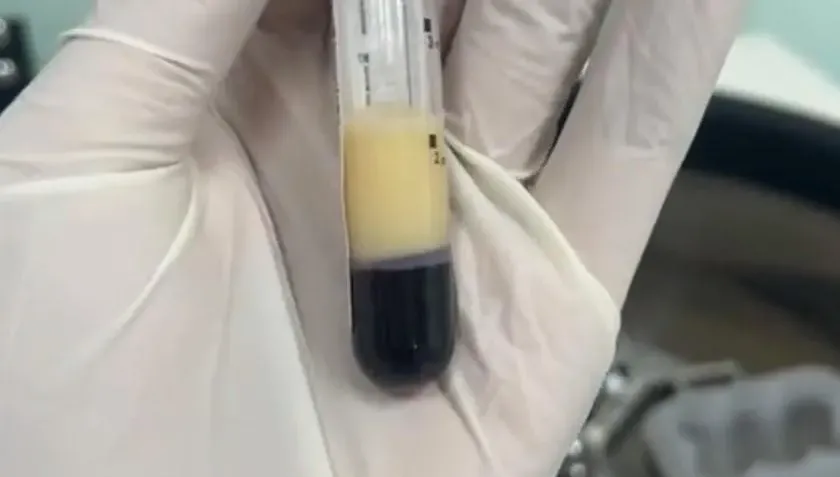 男身體不適就醫竟抽出「牛奶血」！醫曝：酒精熱量超高