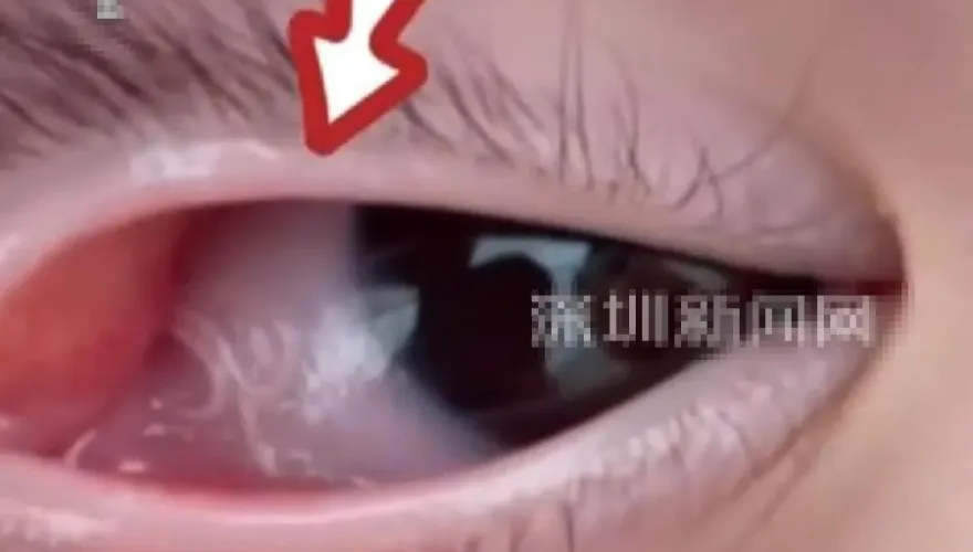 奇癢無比！浙江男眼球竄出「4條蠕動線蟲」...竟是蒼蠅惹的禍