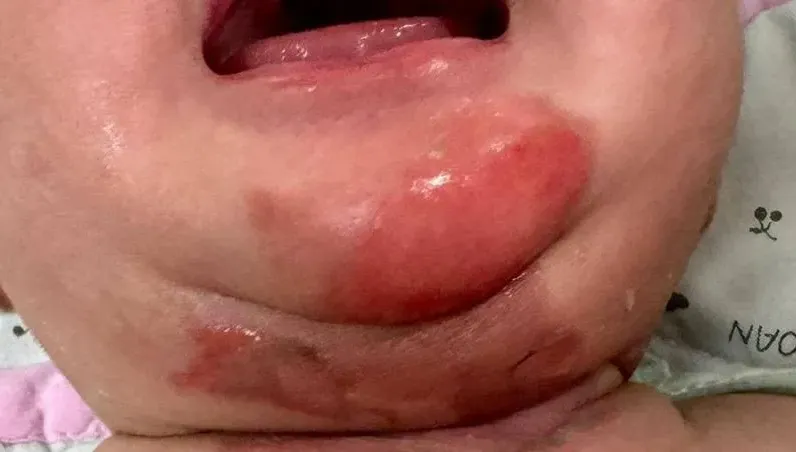 家長嘗試「蒸氣緩解鼻塞」害嬰燙傷！醫示警：刺激鼻黏膜