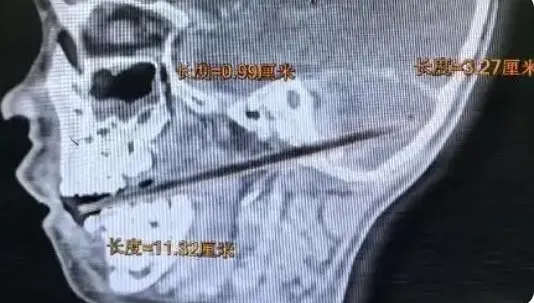 爸媽崩潰！吃麥芽糖不慎摔倒…陸童「竹籤從口插進小腦」