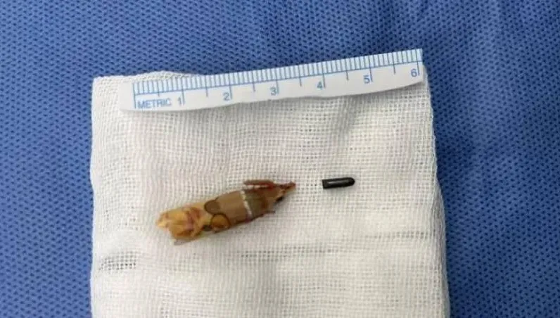 8歲妹被鉛筆刺傷竟慢性骨髓炎　醫開刀驚：筆芯還嵌在腳裡