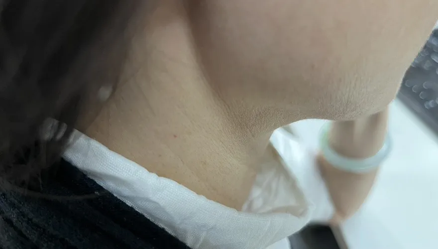 心臟衰竭比癌症更致命！醫揭「頸部靜脈浮起」是重要警訊