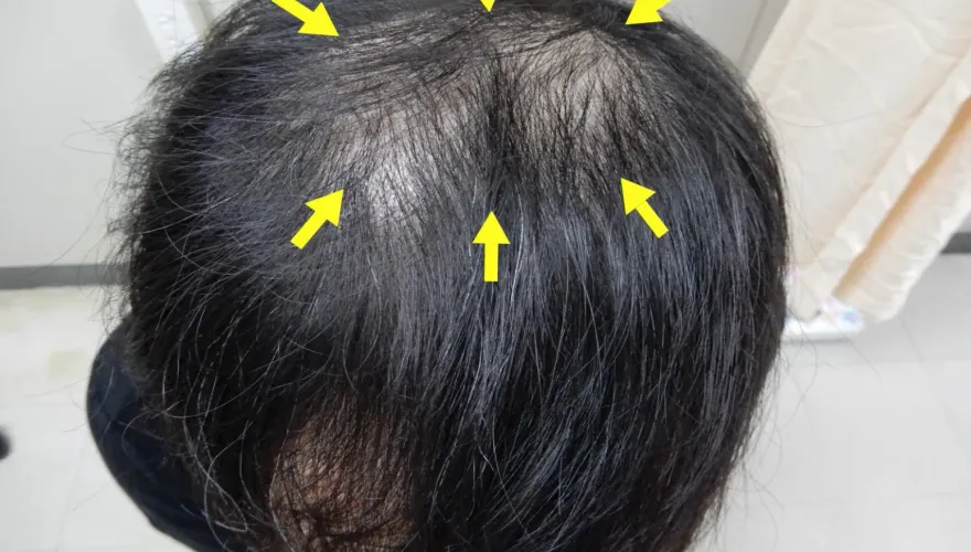3旬男「頭髮越來越少」以為雄性禿　一驗竟是梅毒二期