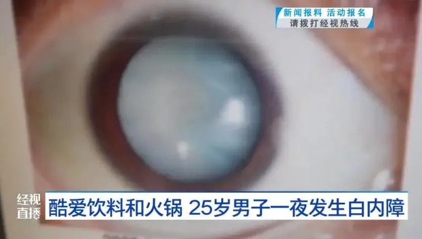 一夜之間「瞳孔全白」！愛喝飲料嗑鍋…25歲陸男患「白內障」