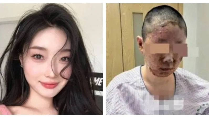 父親一根菸引爆炸！女網紅家毀人傷　「臉被燒爛」拍片自救籌200萬