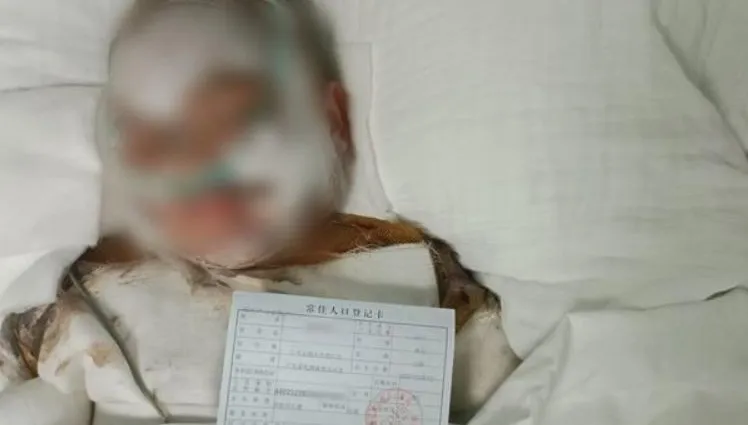 慘！陸5歲童掉進「整鍋滾燙豆漿」　全身80%燙傷命危