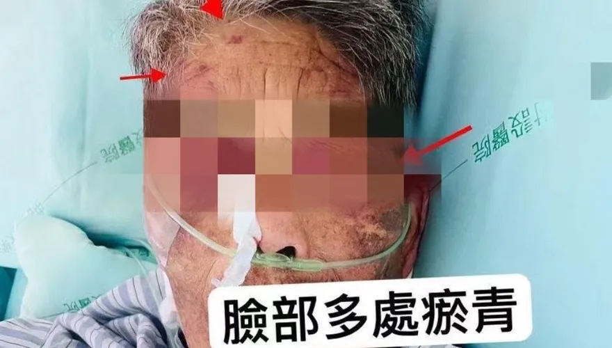 影/台中嬤莫名「瘀青」滿身傷　家屬驚見看護揮打氣炸