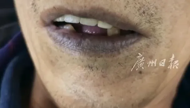 影/禍從口入！陸73歲翁突暈倒＋全身發紫　醃菜含亞硝酸鹽釀禍