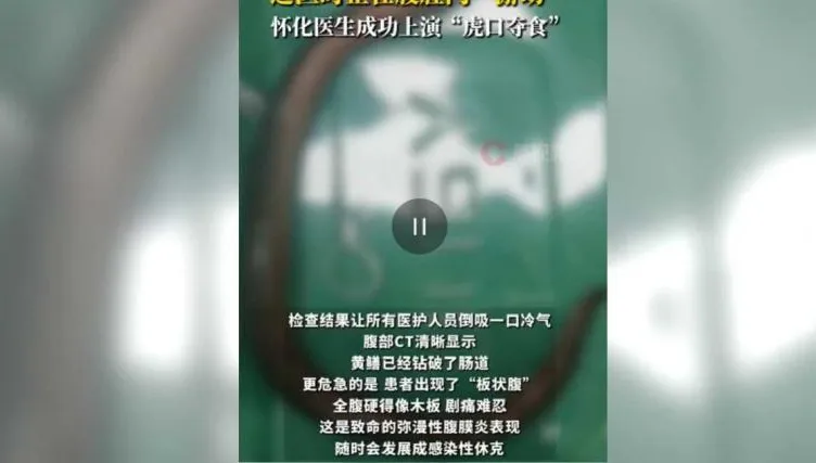 玩好大？　陸30歲男腸內驚見30公分黃鱔