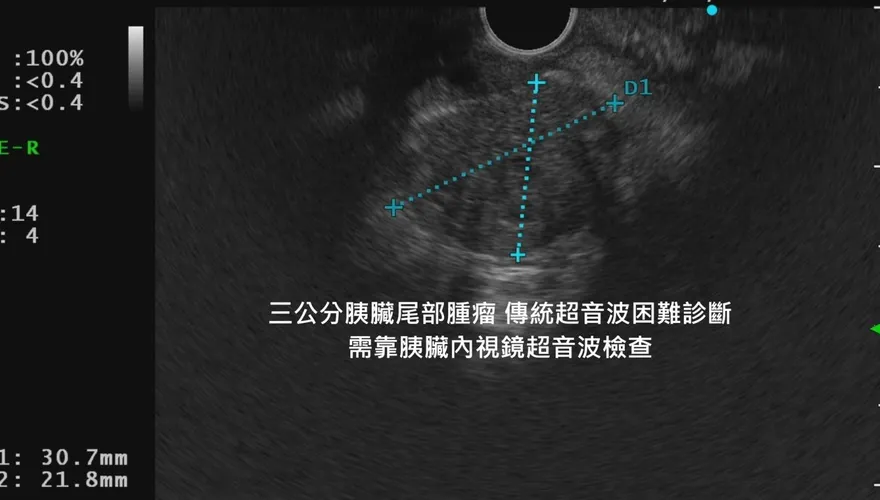 「胰臟癌」潛伏太兇！　醫示警：3種症狀別輕忽