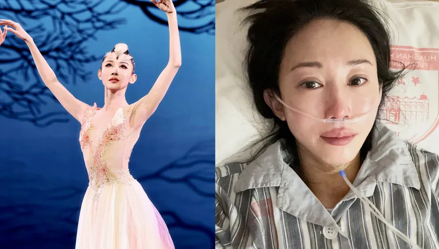 陸知名舞蹈家自曝罹癌！接受25次放化療　帶傷口赴春晚彩排