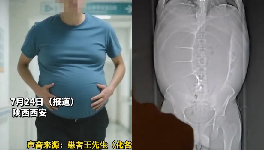 影/滿肚子大便！陸大叔動手術卸載「10分鐘狂排20公斤」