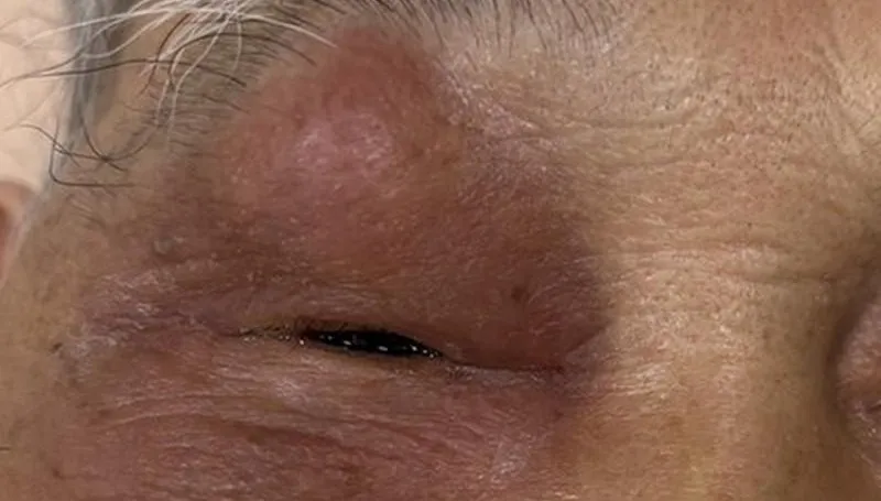 84歲翁「急性鼻竇炎」害眼睛腫脹！醫：嚴重恐致腦膜炎