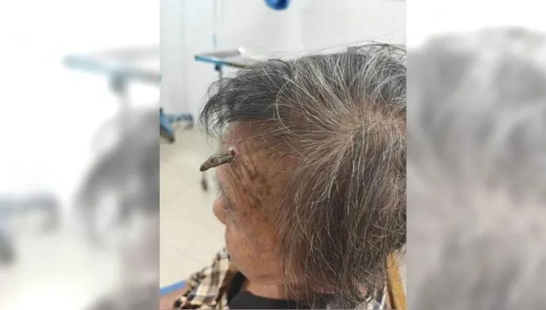 頭長「犄角」拿剪刀喀嚓...98歲上海嬤險大出血丟老命