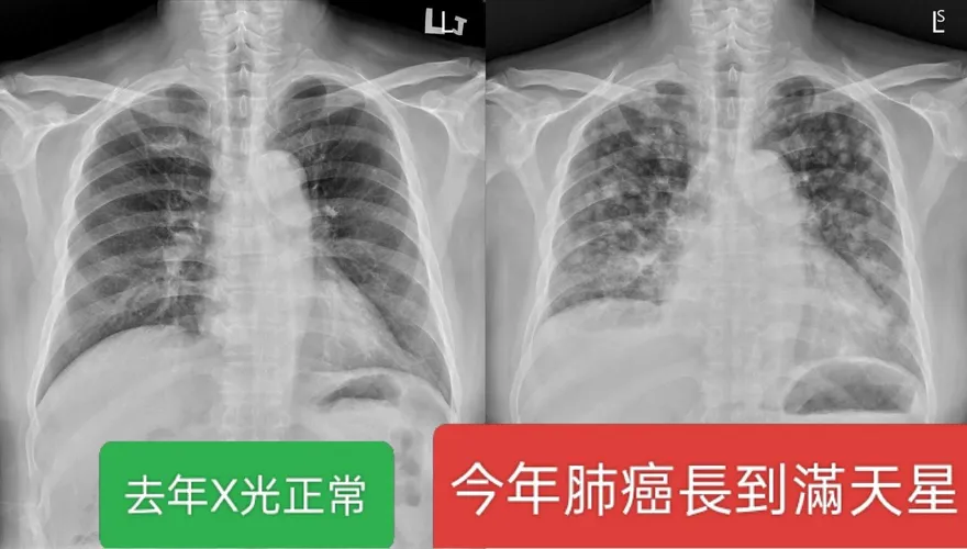 每年照X光都正常　男子竟驗出滿天星肺癌末期