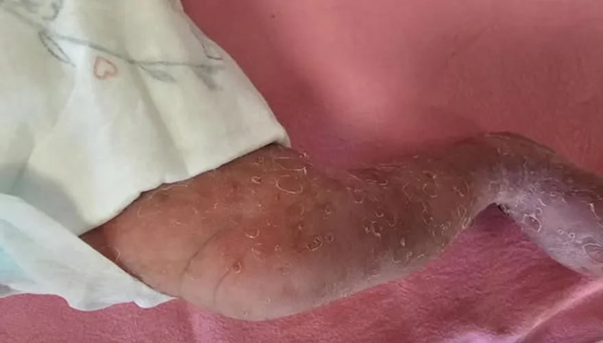 4萬分之1機率！新生女嬰全身紅疹　確診罕見色素失調症