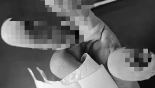 悚！陸女散步誤踩「化骨水」容器　氫氟酸侵蝕慘死