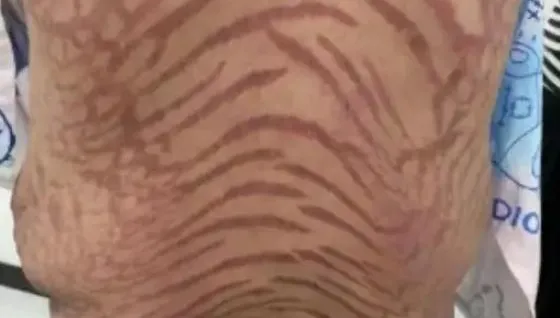 影/嚇人！網購藥膏塗10年　陸女腎上腺異常全身長滿蛇紋