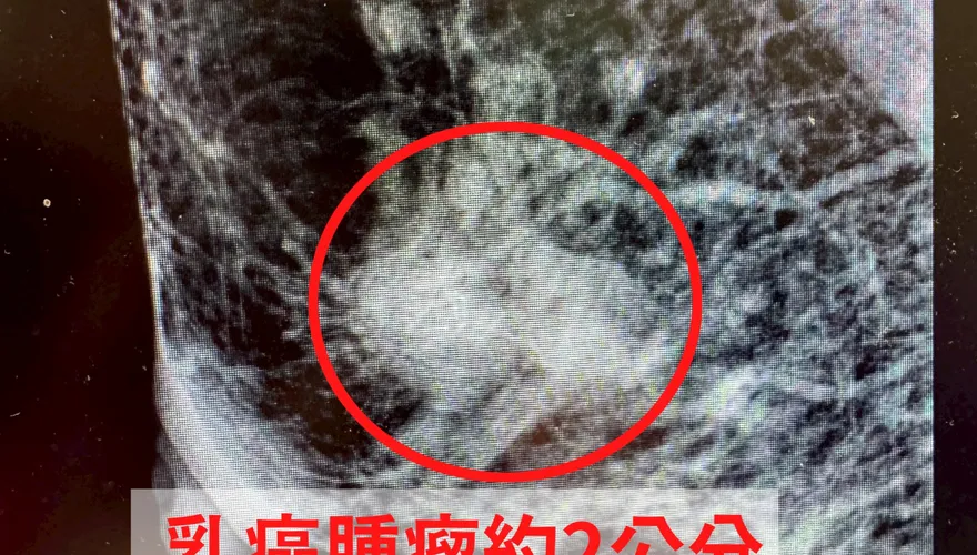 6旬婦「乳頭濕疹」3個月未癒…竟確診罕見乳癌第二期