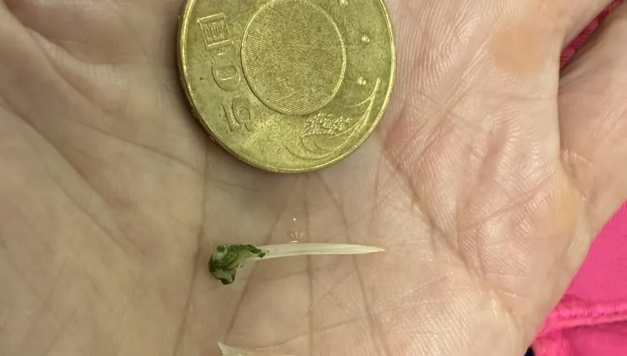 胸痛以為心肌梗塞！他「喝水都痛」竟是3公分魚刺卡食道