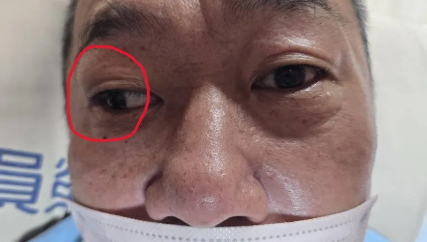 50歲男午睡醒來「右眼無法轉動」！以為中暑竟是腦中風