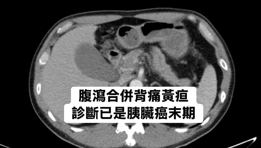 50歲後才得糖尿病要小心！醫：胰臟癌風險是一般人8倍