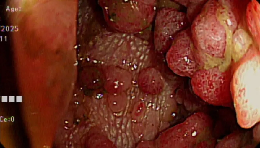 大腸內數百顆瘜肉竟是「致命遺傳」　醫：不治療百分百癌化