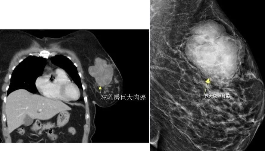 婦人乳房硬塊查出10公分大腫瘤　竟是罕見肉癌