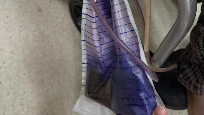 尿袋變紫色非吃錯藥！醫：移除導尿管才能有效控制感染