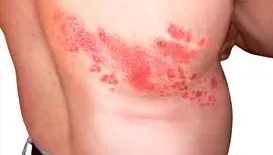 皮蛇纏身如火燒…恐引發永久神經痛！疫苗預防率高達九成