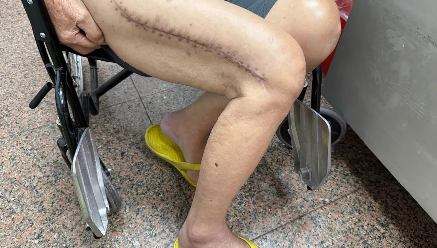 8旬翁大腿骨折三段　三度手術站起：明年要參加媽祖遶境