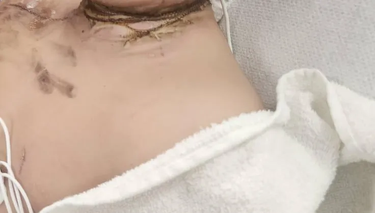 驚悚！睡覺翻身項鏈卡充電器縫隙　美8歲男童觸電燒傷險死