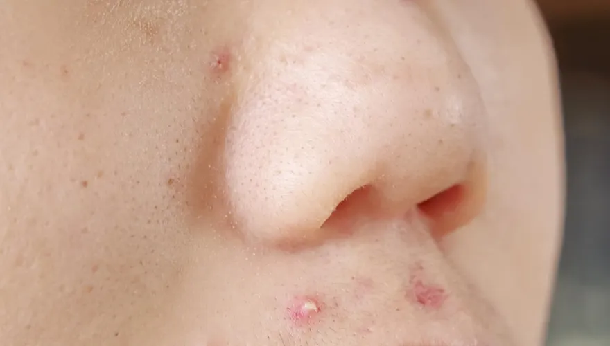 青春痘好困擾！17歲陸男高中生擅服藥　胸部竟異常變大嚇壞