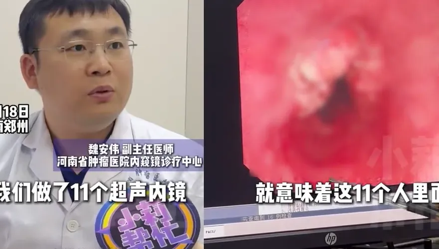 河南醫院一上午「11人確診食道癌晚期」　醫痛心：恐活不過5年