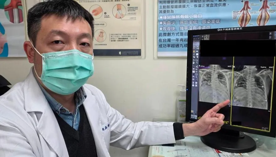 翁染A流「6天變大白肺」！葉克膜搶救15天救回一命