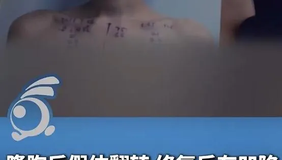 陸女砸17萬隆胸「一翻身就塌」　院方稱可能「尺寸太小」