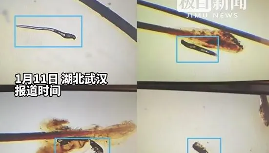 陸女愛化「精緻眼妝」但懶得卸！眼睛奇癢竟藏「6條蟎蟲」嚇傻