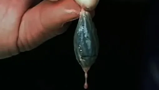信偏方治頭痛！陸婦生吞魚膽引肝衰竭　醫生示警：比砒霜還毒