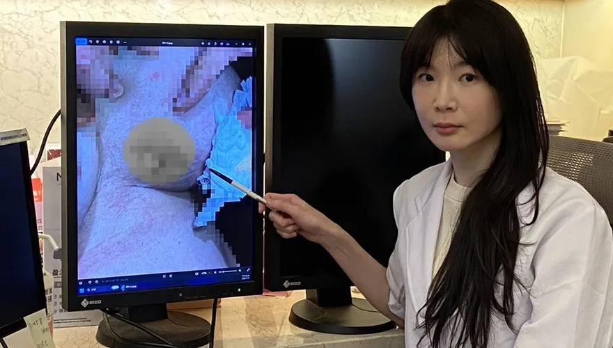 暖暖包夾乳溝9小時！女子燙傷竟沒感覺「脫皮流黃汁」
