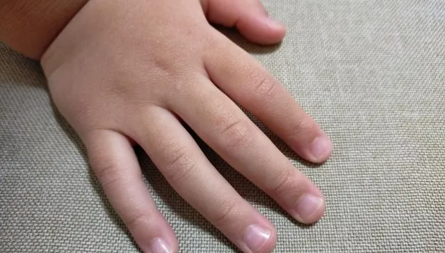 7歲異膚童狂咬指甲講不聽！醫：補鋅、B群比禁止更有效