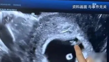 罕見！陸31歲四寶媽又懷雙胞胎　流產半月後體內竟現「第三胎」
