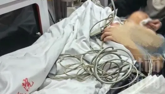 陸女看牙醫被一口氣「拔12顆牙」！下巴脫臼「合不攏」心梗命危