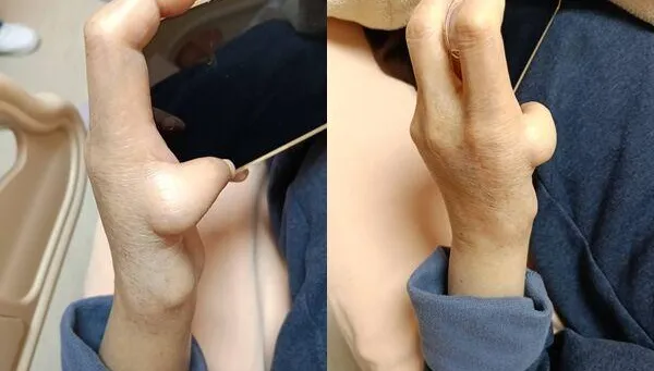 查房見她天生「大拇指超迷你」　蘇一峰解開60年之謎：范可尼貧血！