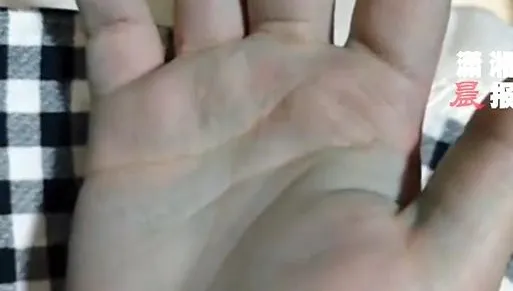陸女煮「牛癟火鍋」一家4口享用！竟「雙手發藍」中毒送醫