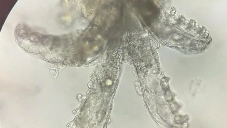 章魚寶寶？女大生紅疹狂冒「毛孔藏滿8腳蟲」　醫：妳餵飽牠們