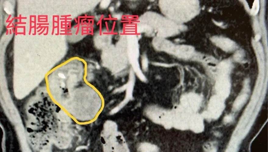 6旬翁愛吃「高油鹽食品」頭暈、易喘　竟是大腸癌三期