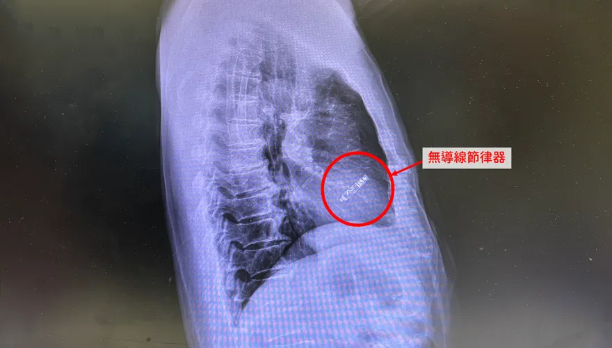 她長期頭暈、昏倒查病因　醫驚：一天「心跳驟停5000次」恐猝死