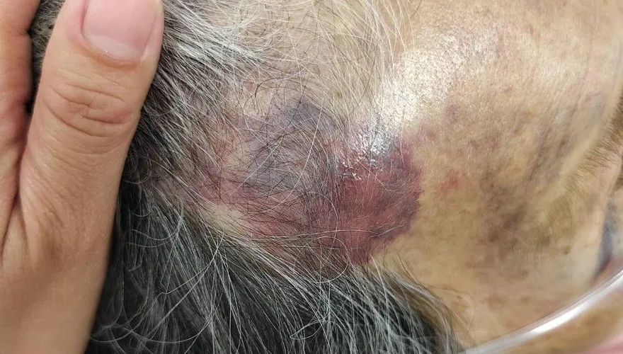 討錢不成！屏東逆孫狂毆90歲嬤　全身瘀青、腦出血送ICU