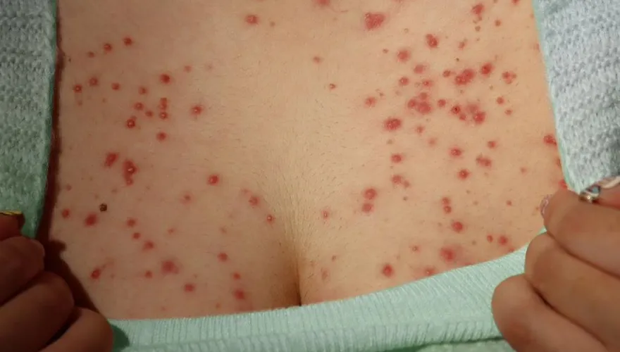 26歲女亂塗藥膏「慘變紅豆胸」　醫：類固醇非萬能！