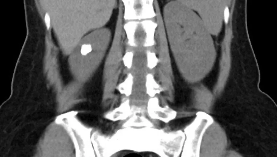 先天腎臟長「囊袋」易積石！罕見異常恐釀感染癌變風險
